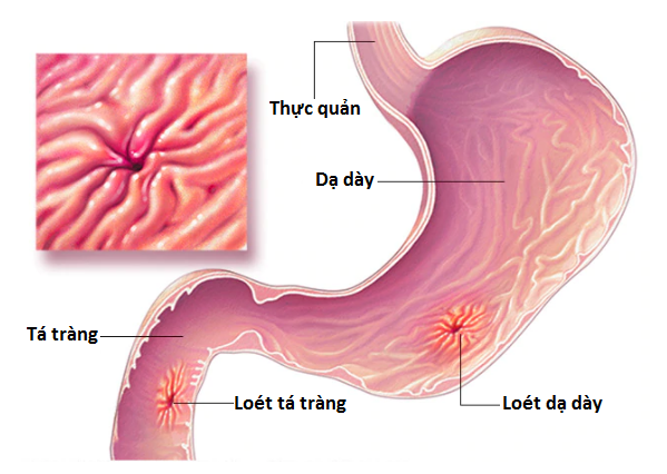 Một người bị triệu chứng thiếu axit trong dạ dày thì sự tiêu hóa  (ảnh 1)