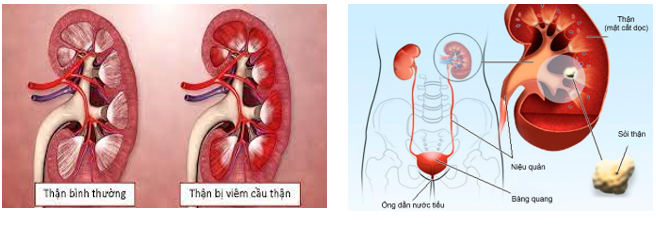 Khi các cầu thận bị viêm và suy thoái có thể dẫn đến những hậu quả nghiêm trọng  (ảnh 1)