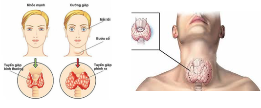Phân biệt bệnh Bazơđô với bệnh bướu cổ do thiếu iốt (ảnh 1)