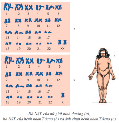 Lý thuyết Sinh học 9 Bài 29: Bệnh và tật di truyền ở người (ảnh 1)